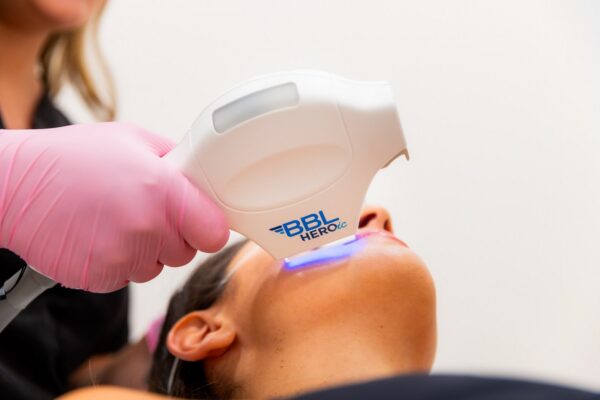 BBL HEROic treatment at Skin Plus Beauty