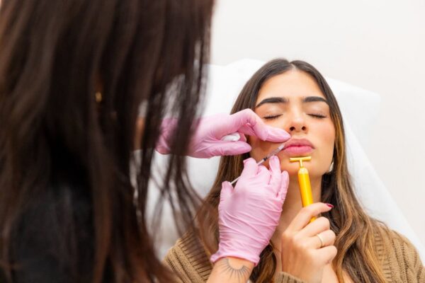 Nasolabial dermal filler injection at Skin Plus Beauty
