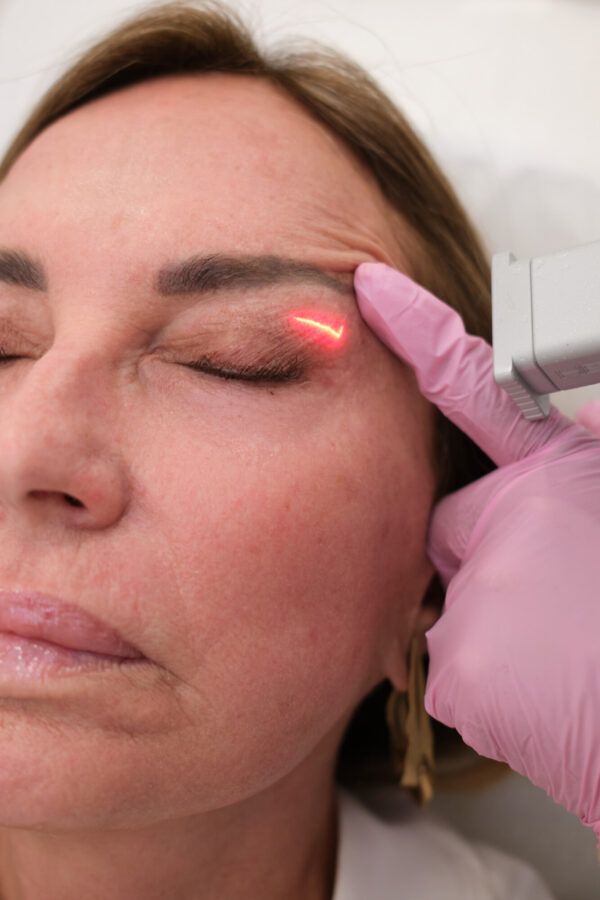 Deka CO2 Eye Rejuvenation