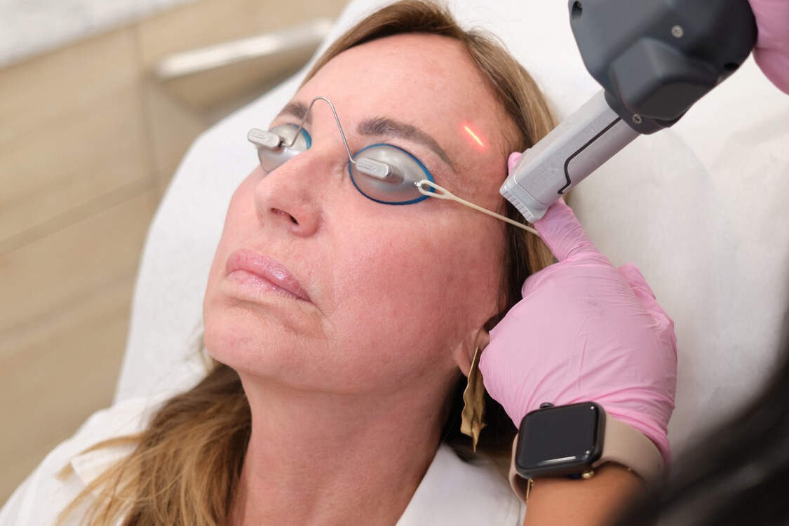 Sultra skin tightening laser treatment at Skin Plus Beauty