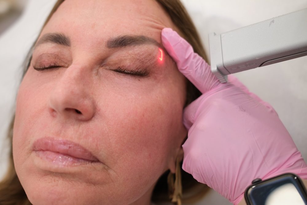 CO2 Eye Resurfacing